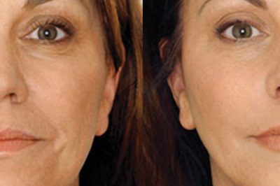 Anti Wrinkle Face Treatment with lipofirm