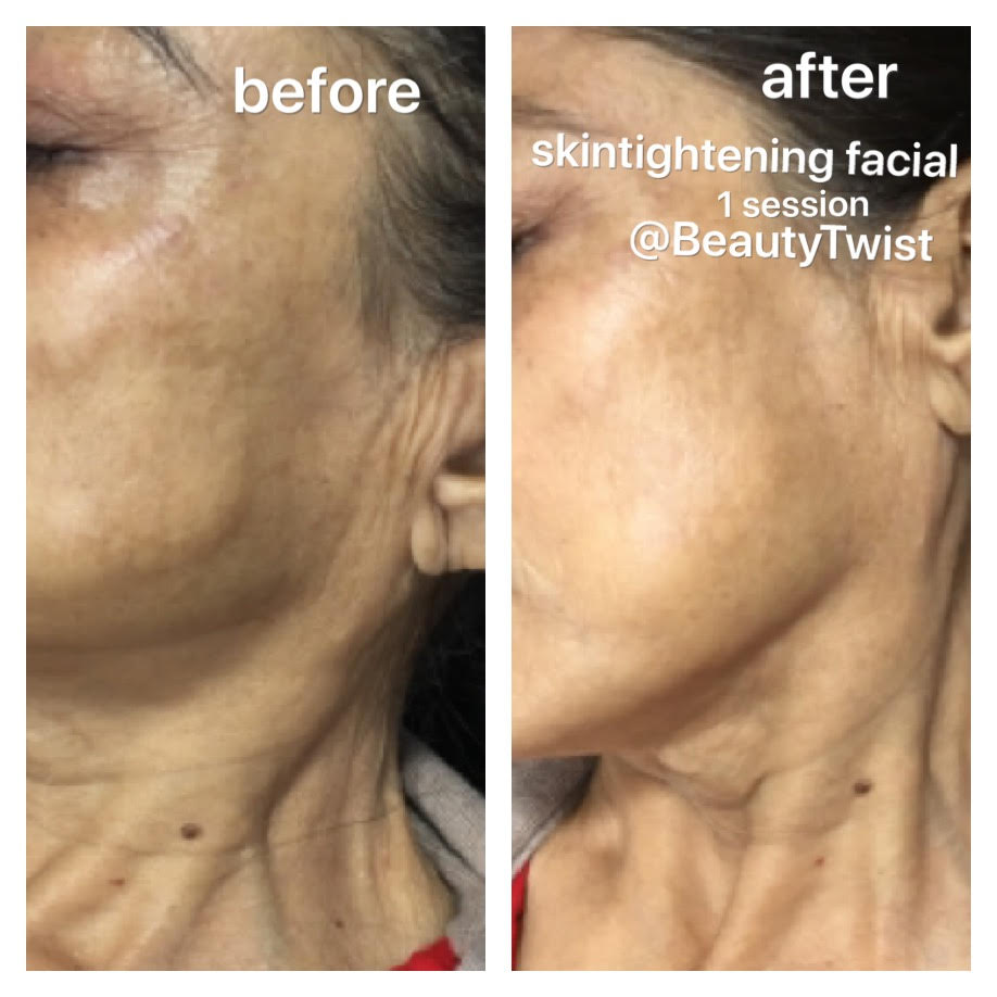 Skin Tightening Facial Treatment