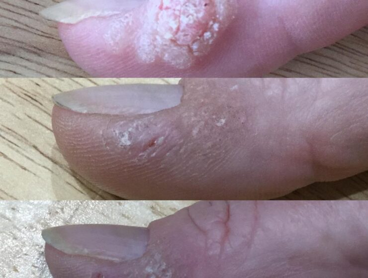 Laser Nail Fungal Removal