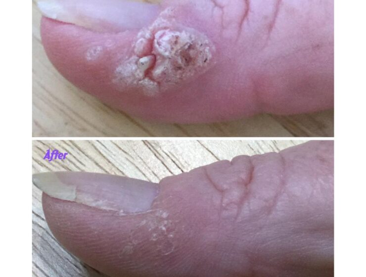 Laser Nail Fungal Removal